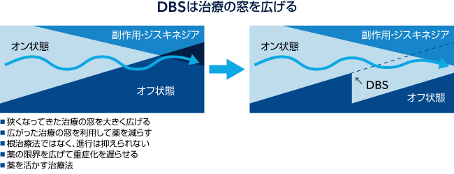DBS は治療の窓を広げる
