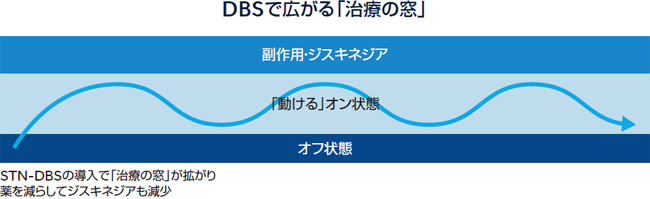 DBS で広がる「治療の窓」